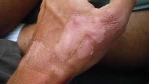 P1000917_3264x1840 Part II: Don't put your fingers in campfires kids. (Just kidding, that is just my awful sunburn peeling. It really looked gross for a few days, as you can see).
