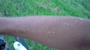 There were a lot of tiny bugs out. They went for the eyes and mouth, but as you can see some missed and only got my arm.